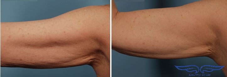 Exilis Treatment in Irvine CA Before After Upper Arm 