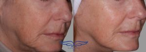 Exilis Before and After of Jaw Orange County