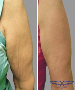 Exilis treatment in Laguna Niguel Before After Arm