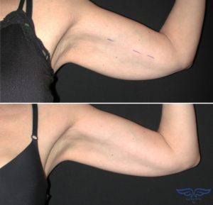 Exilis Treatment in Laguna Niguel Before After Arm