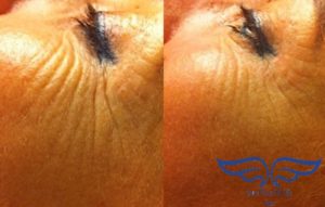 Exilis Before After Crows Feet Orange County