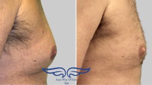 Exilis treament in Laguna Niguel Before After Male Chest