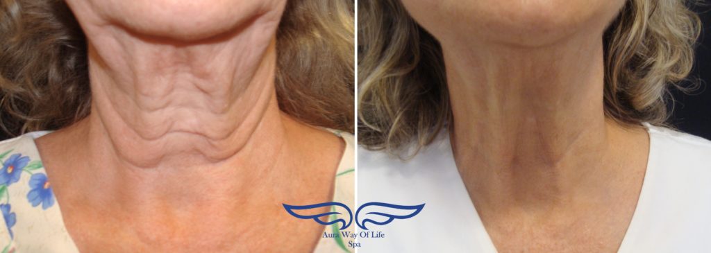 Exilis Treatment in Irvine CA Before After Neck