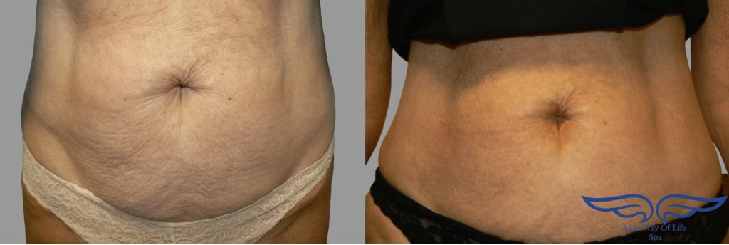 Exilis Treatment in Irvine CA Before After Stomach 