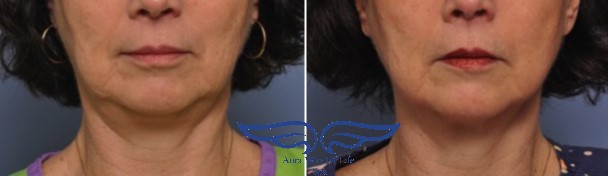 Exilis Treatment in Irvine CA Before After Lower Jaw 