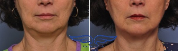 Exilis Treatment in Irvine CA Before After Lower Jaw