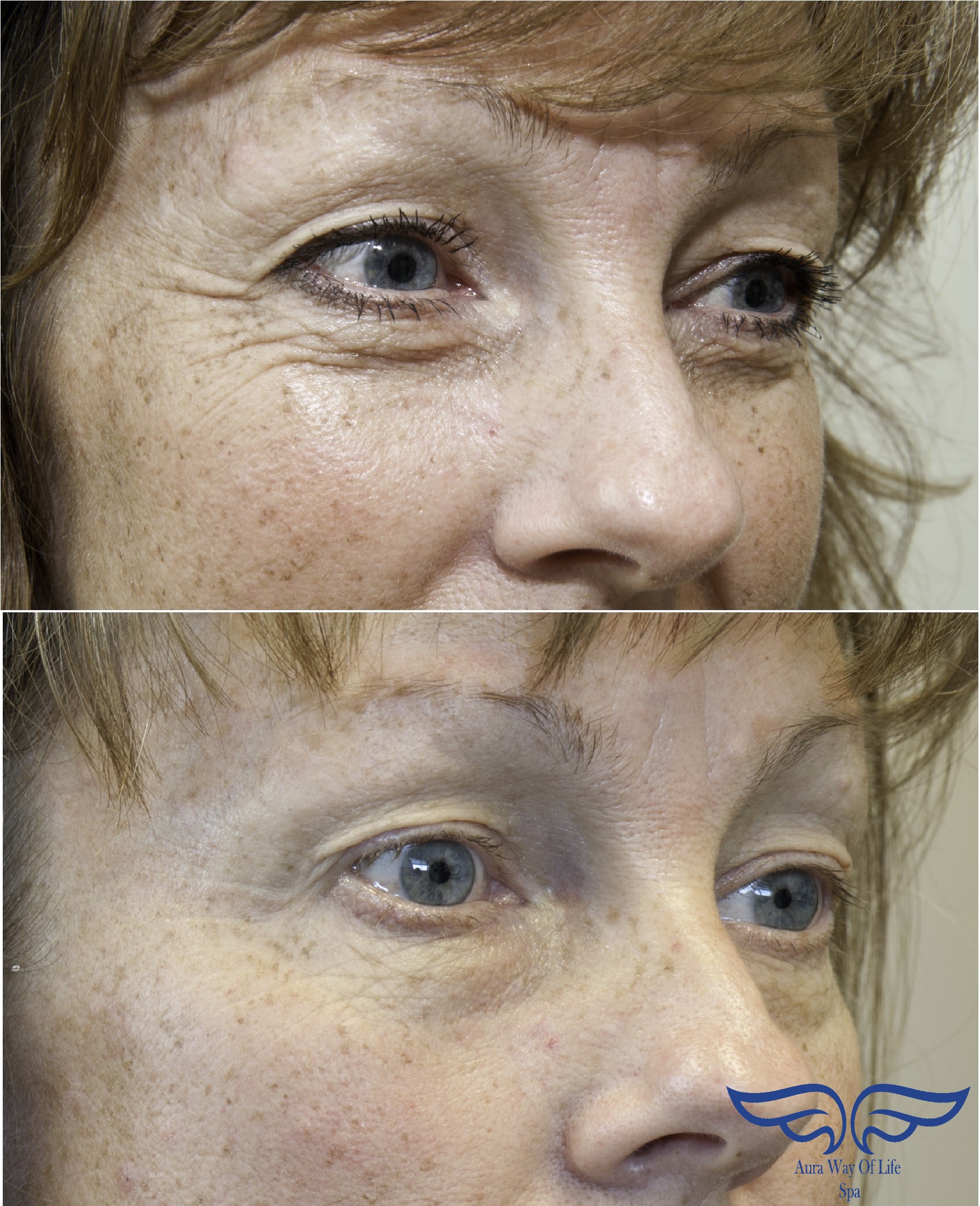 Exilis Before and after eyes Orange County