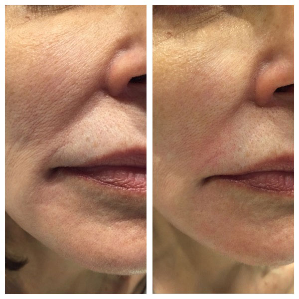 Exilis Before and After Mouth