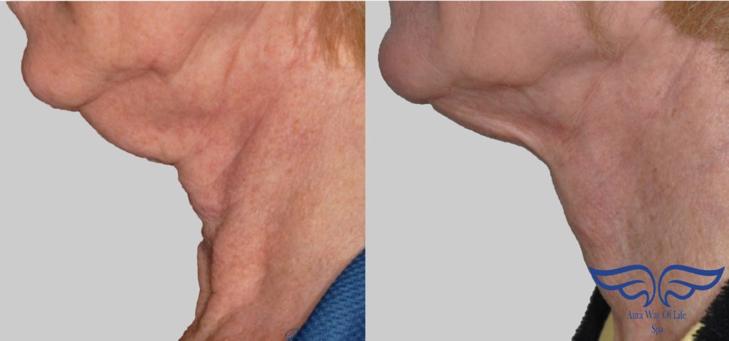 Exilis Skin Tightening in Orange County Before After Neck