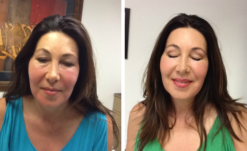 exilis cost in orange county face