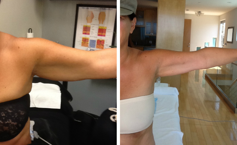 Exilis cost in Orange County triceps before and after