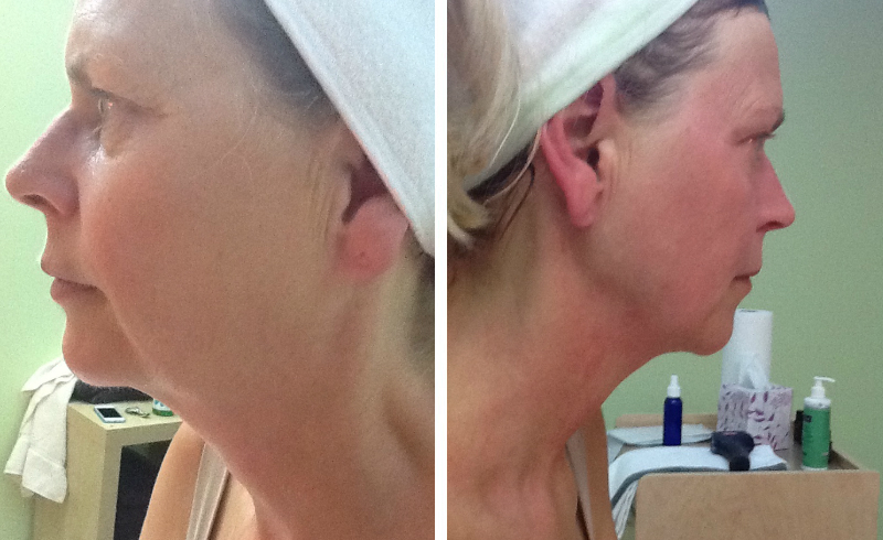 exilis cost in orange county before after jaw