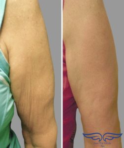 Exilis skin tightening Irvine of Arm.