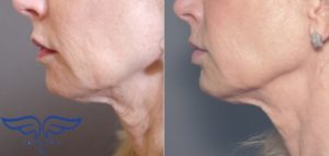 Exilis Skin Tightening Irvin Jawline