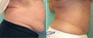 Exilis Skin Tightening Irvine Male Abs