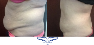 Exilis cost in Orange County abdonmen 